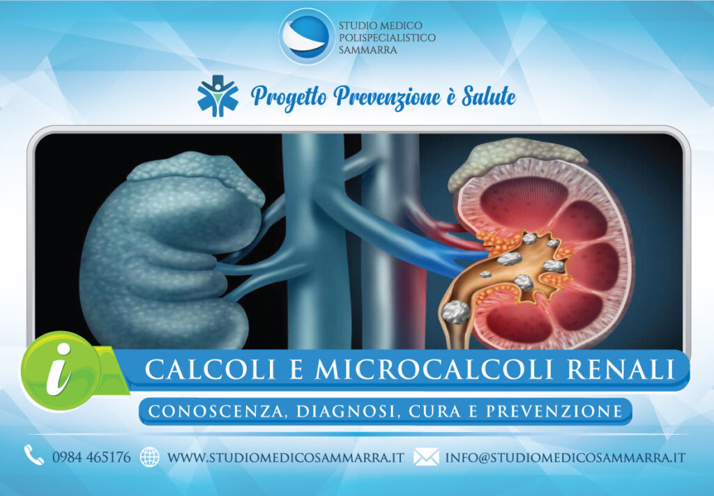 Calcoli e microcalcoli renali a Cosenza e Rende Studio Medico Sammarra
