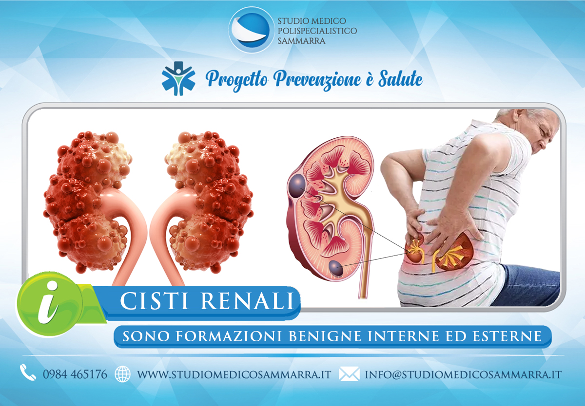 Le Cisti Renali a Cosenza e Rende