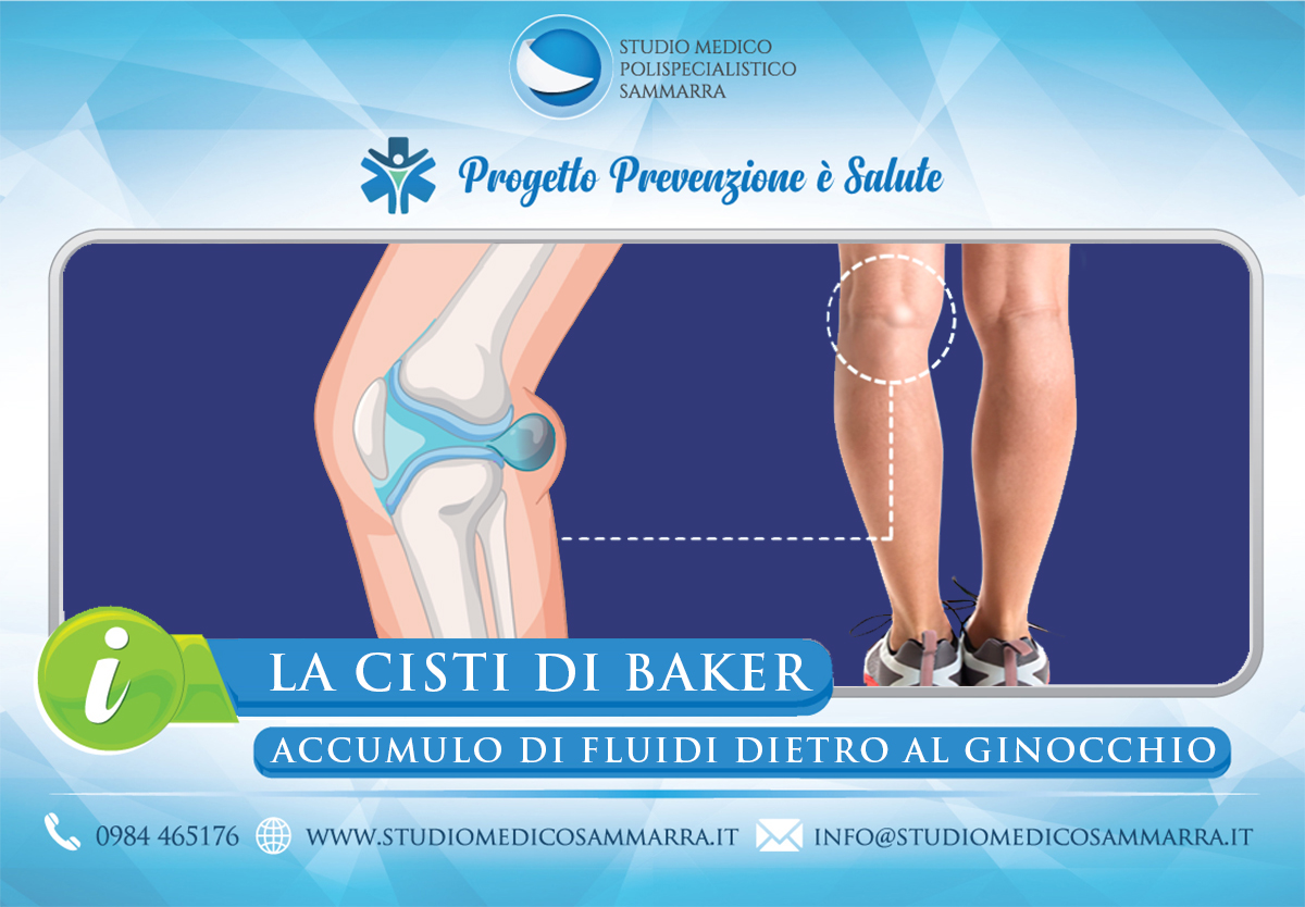 La Cisti di Baker a Cosenza e Rende