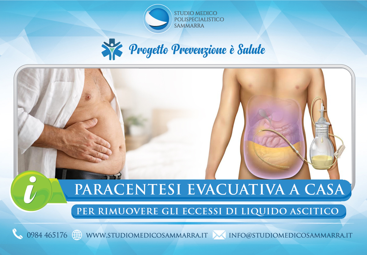 Paracentesi Evacuativa a Domicilio a Cosenza e Rende
